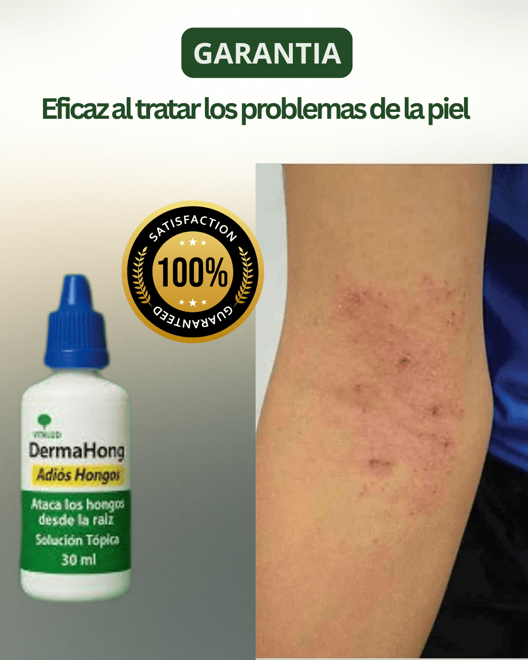 Dermahong Tratamiento removedor de hongos - Definitivo